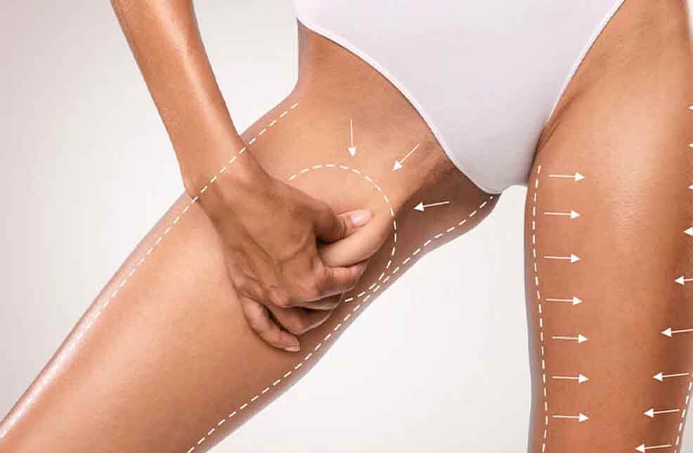 Picture of perfectly shpaed thighs after body conturing plastic surgery