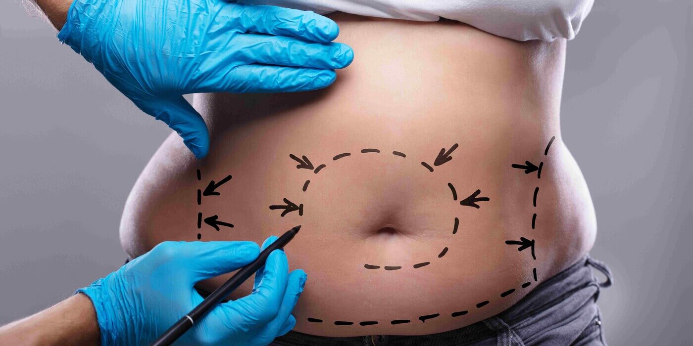 Picture of the abdomen before body conturing plastic surgery