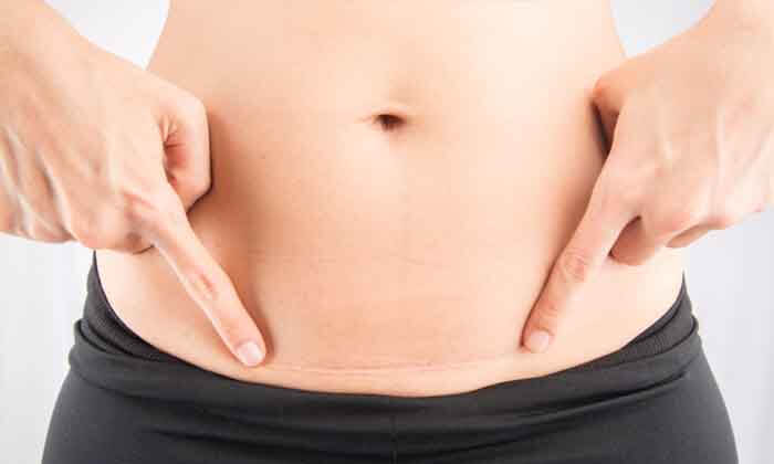 Picture of a woman showing her scar after a mini tummy tuck